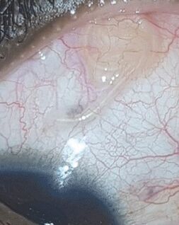 NEOflorax ajudou a se livrar de um verme no olho